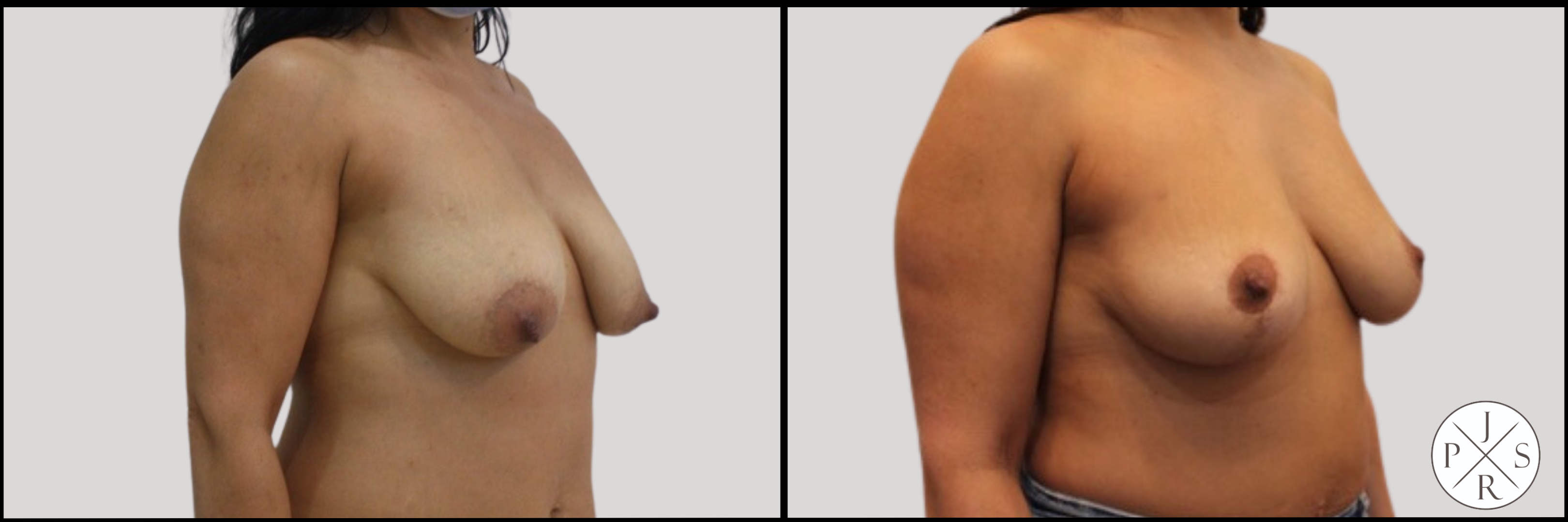 Fat Transfer Breast Augmentation Before & After Image